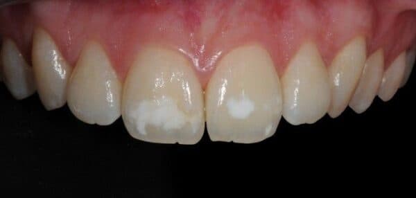 Xem xét cần thiết về bổ sung fluor