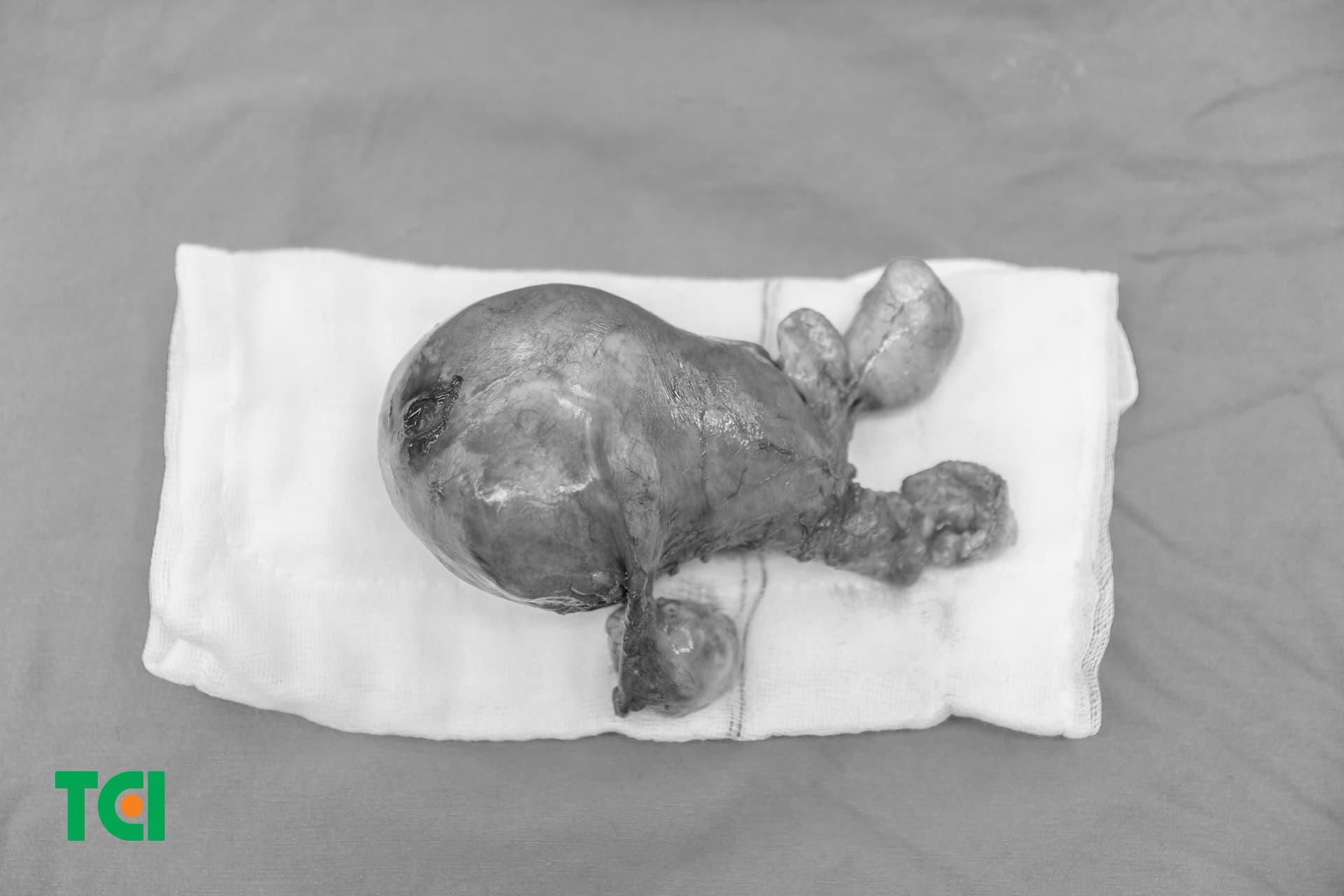 Đa nhân xơ tử cung cùng tử cung, buồng trứng sau phẫu thuật