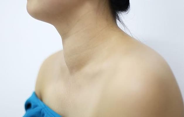 U tuyến giáp khiến vùng cổ phình lớn mất thẩm mỹ.