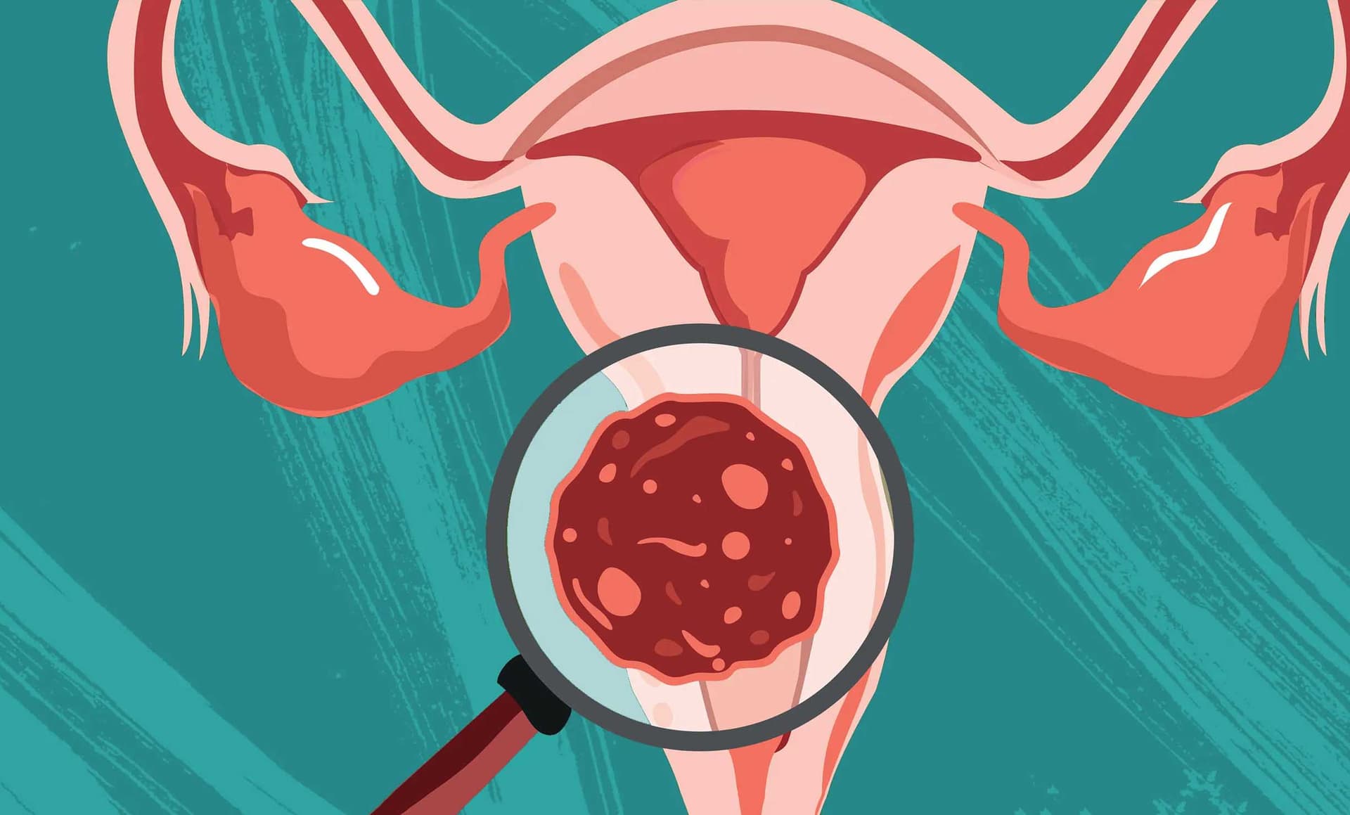 Nguyên nhân gây ra ung thư cổ tử cung có thể đa dạng, nhưng phần lớn do lây nhiễm virus HPV qua đường tình dục