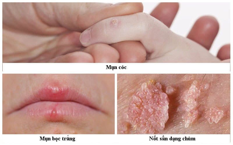 Sùi mào gà (mụn có sinh dục) gây ra do virus HPV ở người
