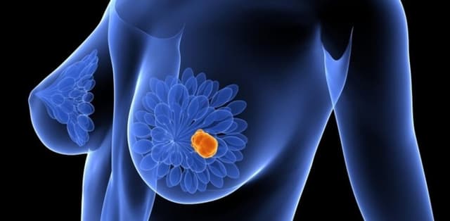 Nhân giảm âm tuyến vú có gây nguy hiểm?