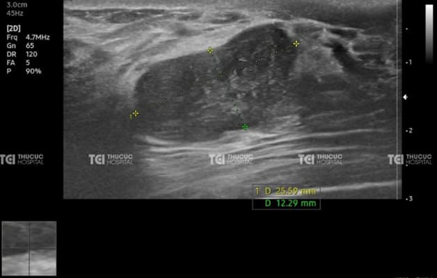 Hình ảnh nhân giảm âm tuyến vú được phát hiện qua siêu âm tại Thu Cúc TCI.