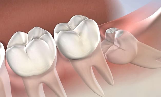 Răng khôn mọc lệch