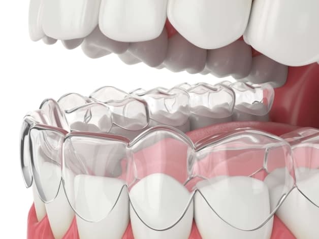 Phương pháp niềng răng Invisalign