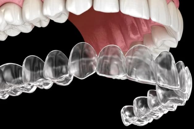 Niềng răng Invisalign