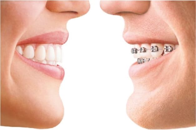Niềng răng trong suốt và truyền thống