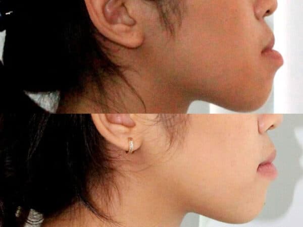 Sự thay đổi khi niềng răng trước và sau có nhiều thay đổi tích cực và khiến ban xinh đẹp hơn.