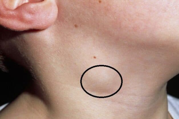 Triệu chứng ung thư vòm họng nổi hạch cổ