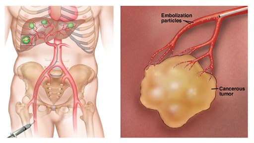 ưu điểm và lưu ý sau nút mạch gan