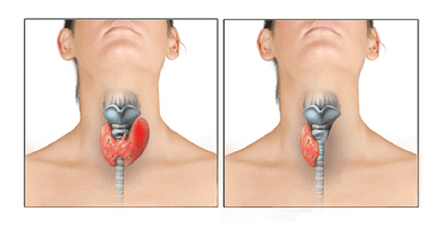 Phẫu thuật trong điều trị bệnh ung thư tuyến giáp