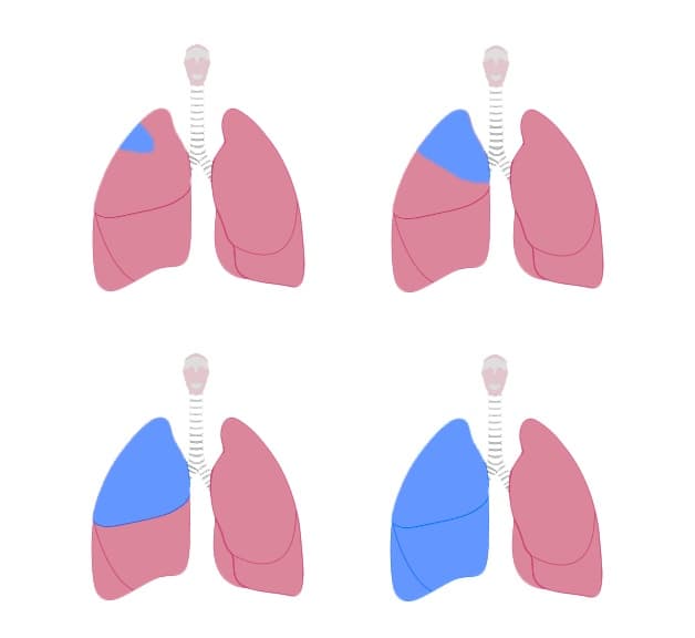 Cách chữa trị ung thư phổi bằng phẫu thuật
