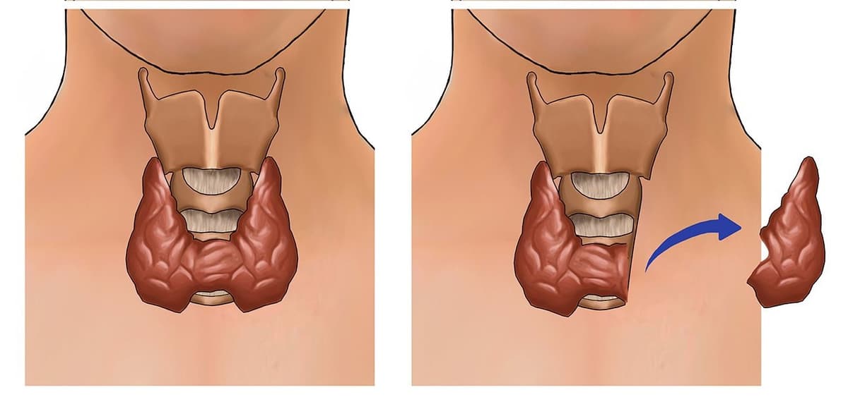 Phẫu thuật trong điều trị ung thư tuyến giáp
