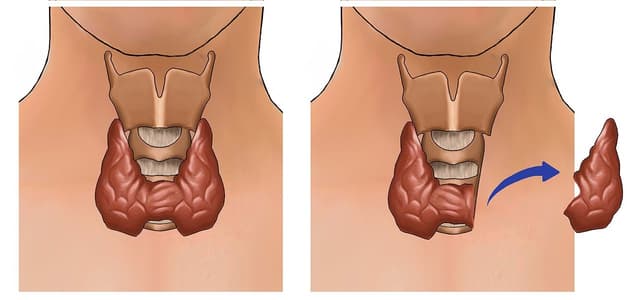 Phẫu thuật trong điều trị ung thư tuyến giáp
