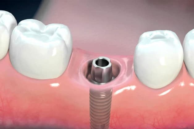 Cấy ghép Implant