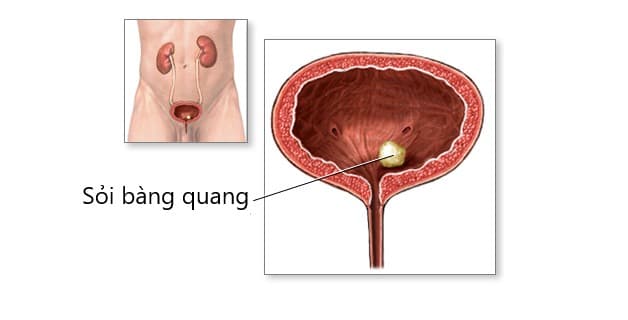 Những thông tin cơ bản về sỏi bàng quang