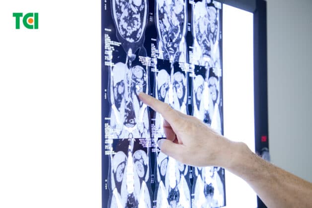 Các phương pháp chữa sỏi thận bằng công nghệ cao