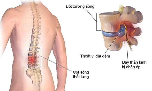 Thoát vị đĩa đệm cột sống thắt lưng là gì?