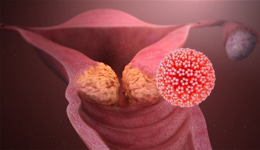 Ung thư cổ tử cung thường xuất phát từ một loại virus gọi là Human Papillomavirus (HPV)