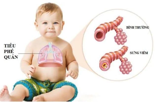 Trẻ bị viêm tiểu phế quản có nguy hiểm không?