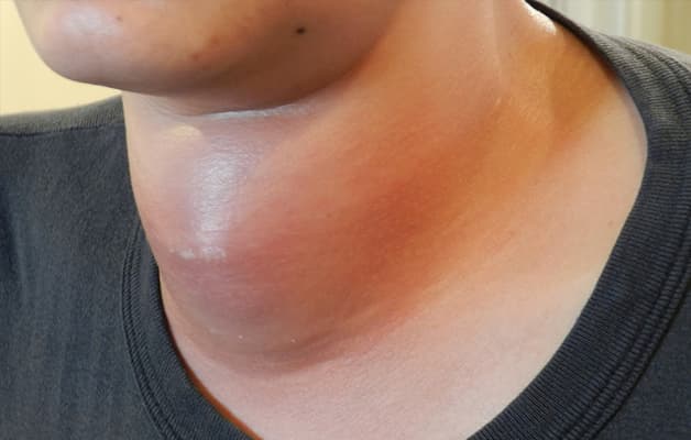 Đau vùng tuyến giáp kèm sưng, nóng có thể cảnh báo bệnh lý viêm tuyến giáp.