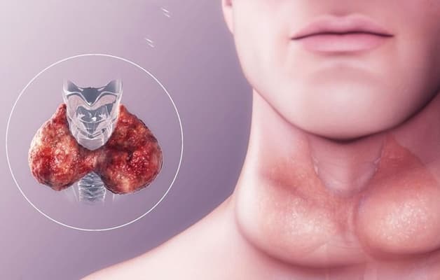 Tuyến giáp to cảnh báo dấu hiệu ung thư tuyến giáp.