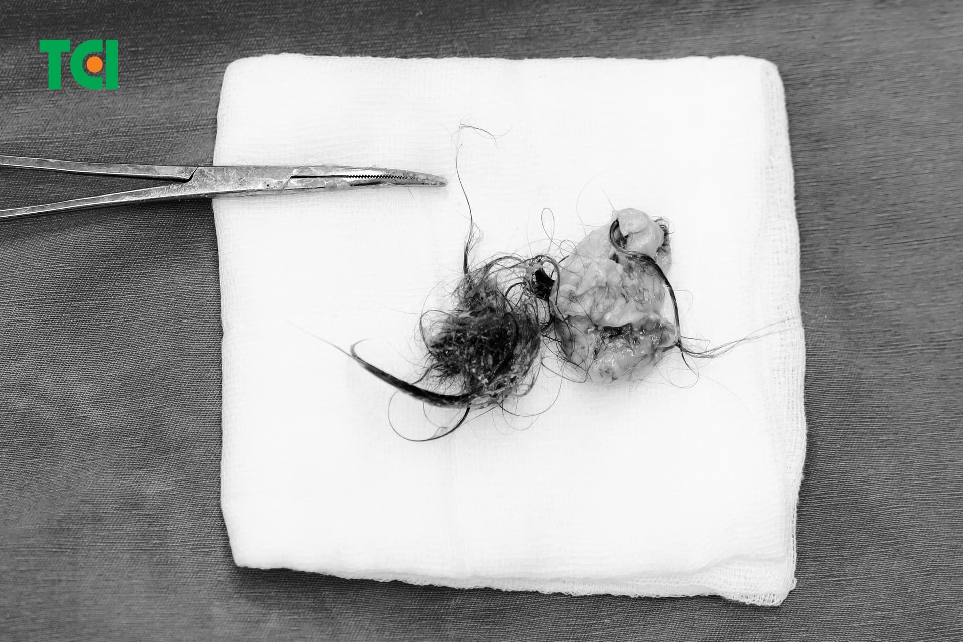 Khối u bì buồng trứng sau phẫu thuật