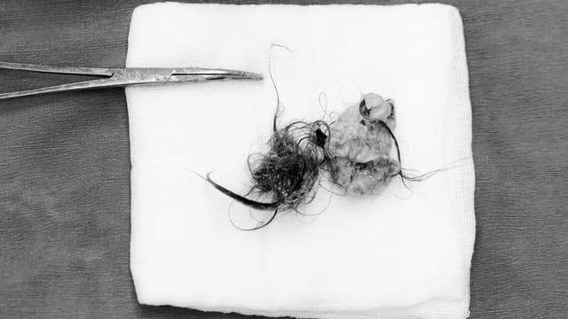 Phẫu thuật nội soi “giải quyết” u quái buồng trứng