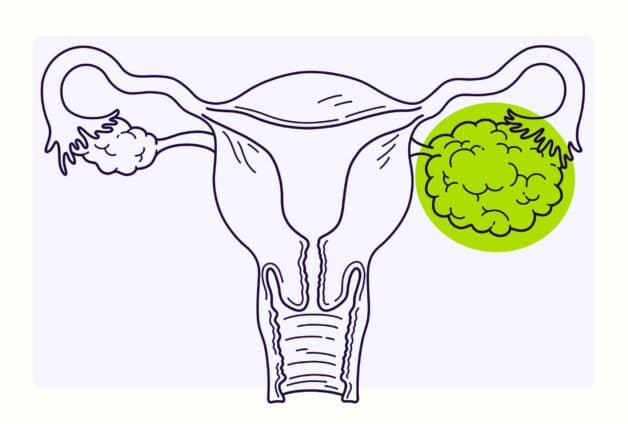 Ung thư buồng trứng và ung thư cổ tử cung