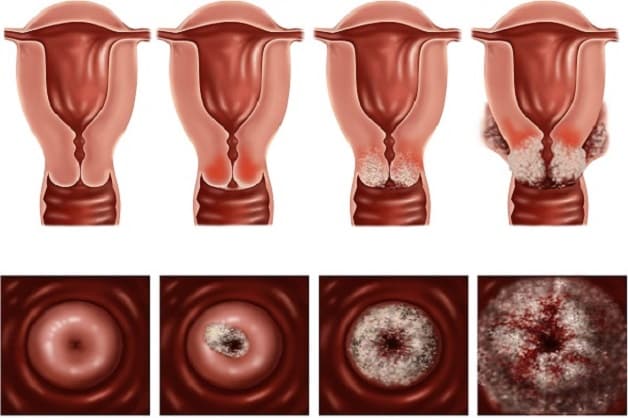 Ung thư buồng trứng và ung thư cổ tử cung
