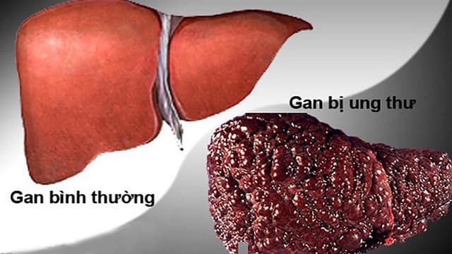 Những phương pháp điều trị ung thư gan mới nhất