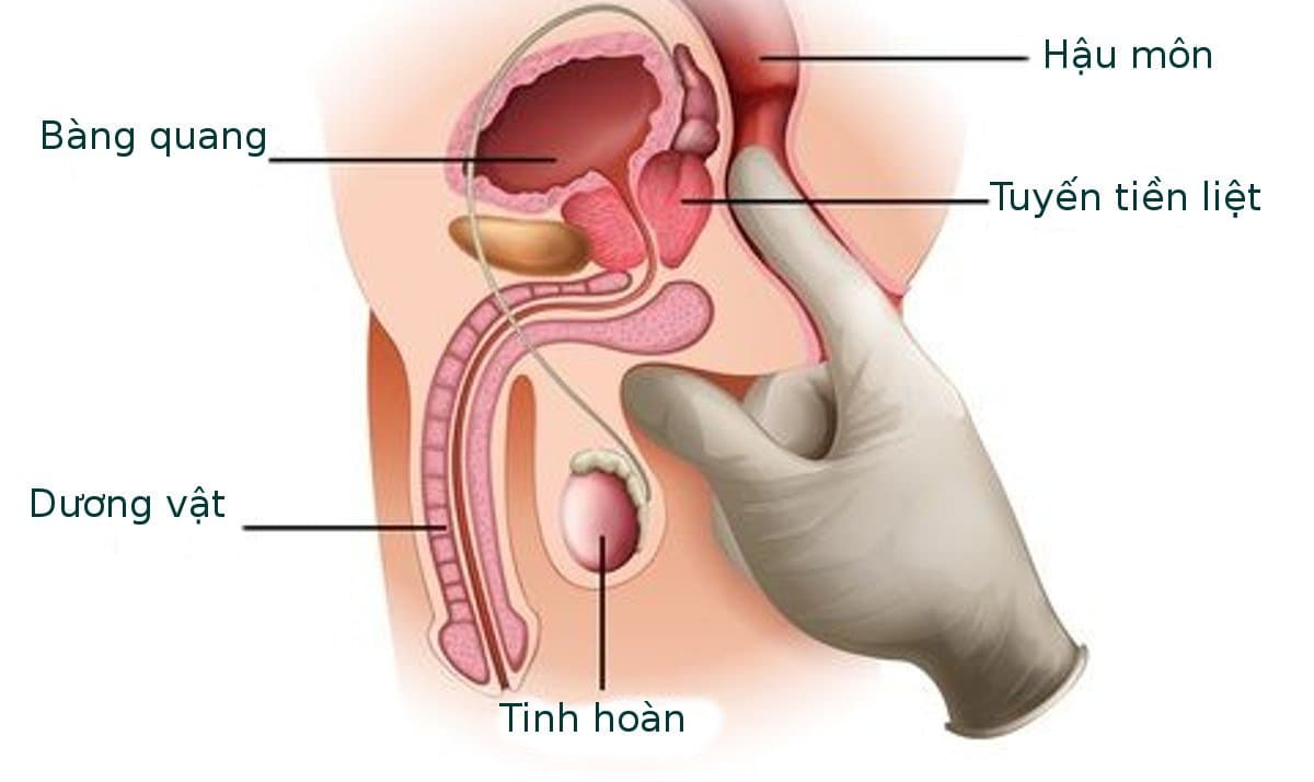 Tìm hiểu về bệnh ung thư tuyến tiền liệt ở nam giới