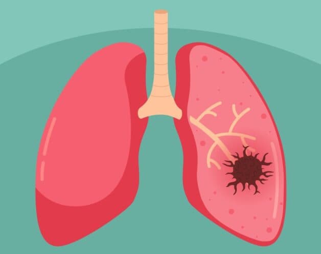 Sơ lược về bệnh ung thư phổi không tế bào nhỏ