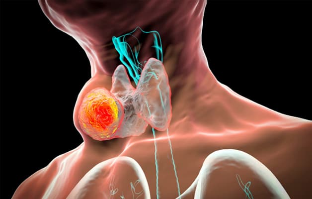 Ung thư tuyến giáp có xu hướng tăng qua các năm.