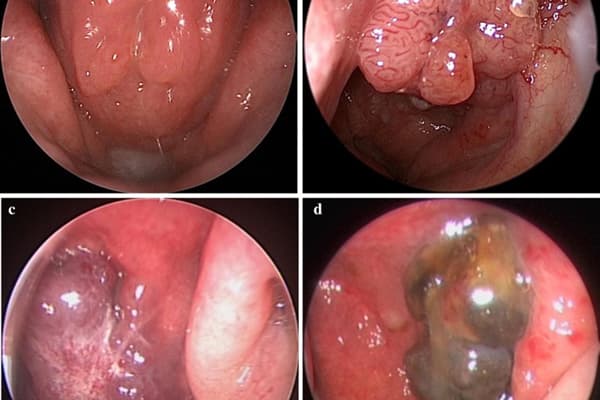 khái niệm của bệnh ung thư vòm họng