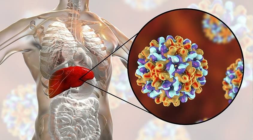 Virus viêm gan B (HBV) gây ra viêm gan B