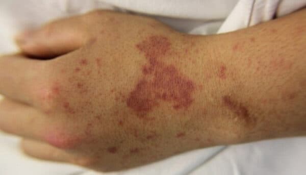 vacxin viêm não mô cầu