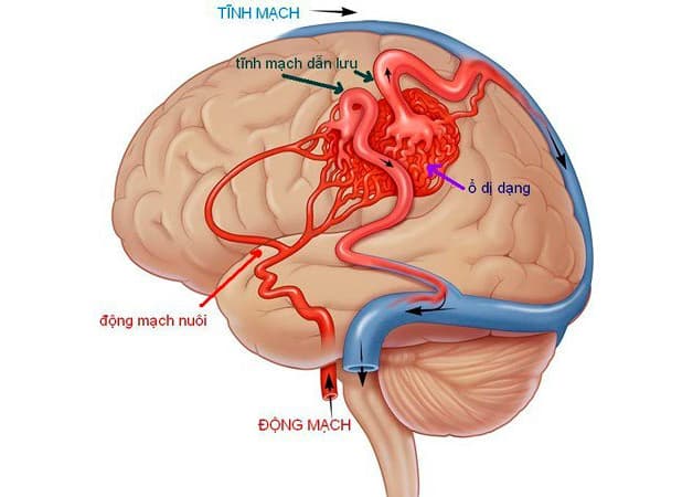 Dị dạng mạch máu não là một trong những nguyên nhân vì sao đột quỵ ở trẻ em xảy ra.