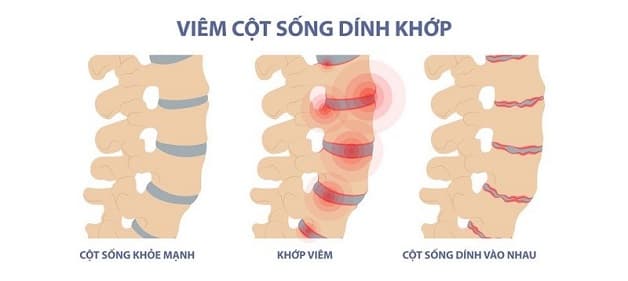 Viêm cột sống dính khớp là bệnh gì?