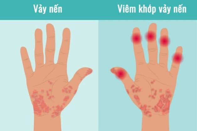 Viêm khớp vẩy nến gây ra nhiều triệu chứng, biến chứng nguy hiểm nên cần được điều trị đúng cách