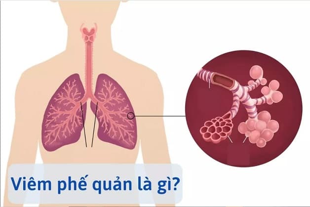 Viêm phế quản cấp là gì?