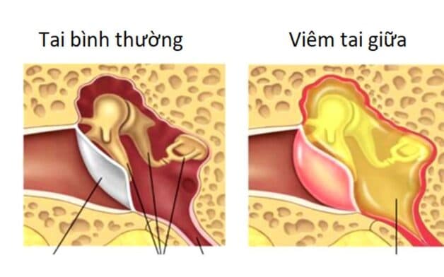 chứng viêm tai giữa người lớn
