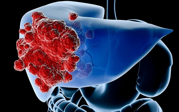 Xơ gan biến chứng ung thư gan như thế nào?
