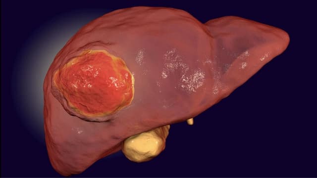 Tìm hiểu chung về những dấu hiệu xơ gan ung thư gan