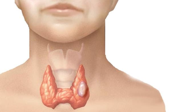 Nang tuyến giáp là gì là câu hỏi nhiều người thắc mắc