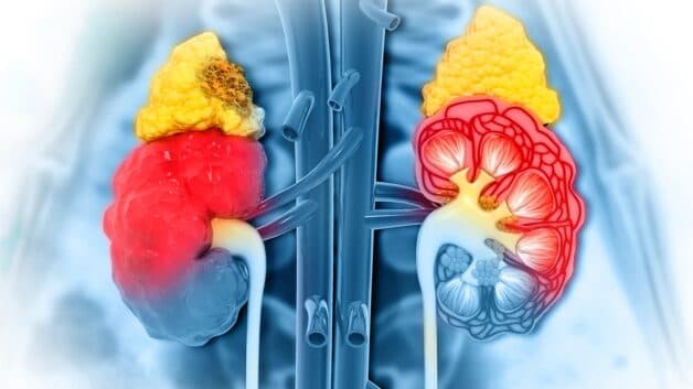 U tuyến thượng thận ác tính