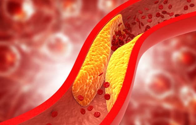 Ai có thể bị đột quỵ - người mắc bệnh máu nhiễm mỡ.