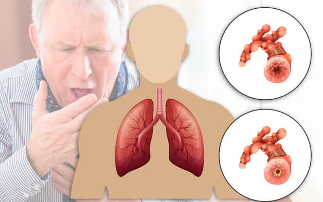 Chi tiết bệnh COPD phổi tắc nghẽn mạn tính giai đoạn 3