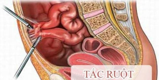 Bệnh lồng ruột là nguyên nhân phổ biến khiến bé bị tắc ruột