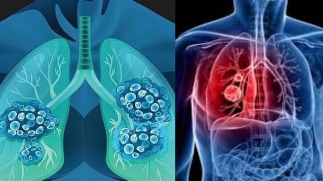 Tổng hợp những triệu chứng của bệnh ung thư phổi